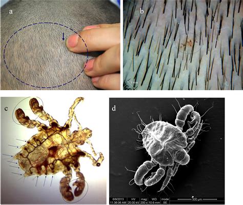 +1-410-502-7683 International. . Mites skin parasite that looks like human hair